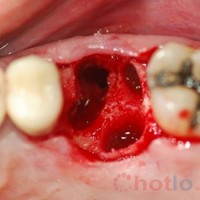 Mơ thấy rụng răng thì đánh lô đề con gì